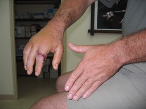 hand injury 027